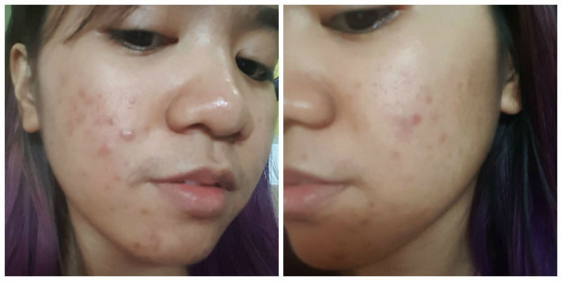 centellian 24 madeca cream review - allergic reaction