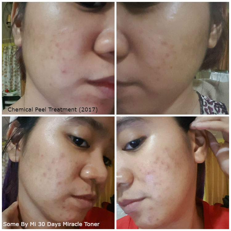 chemical peel treatment vs some by mi aha bha pha 30 days miracle toner