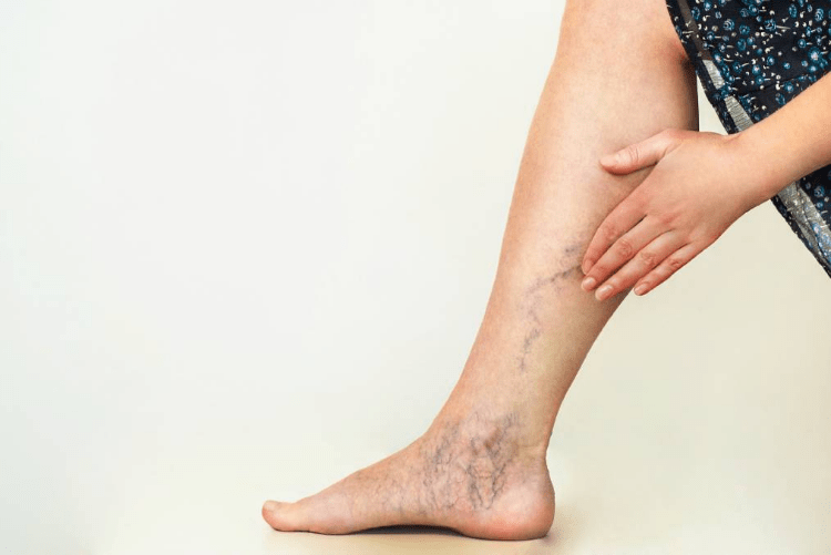 varicose veins